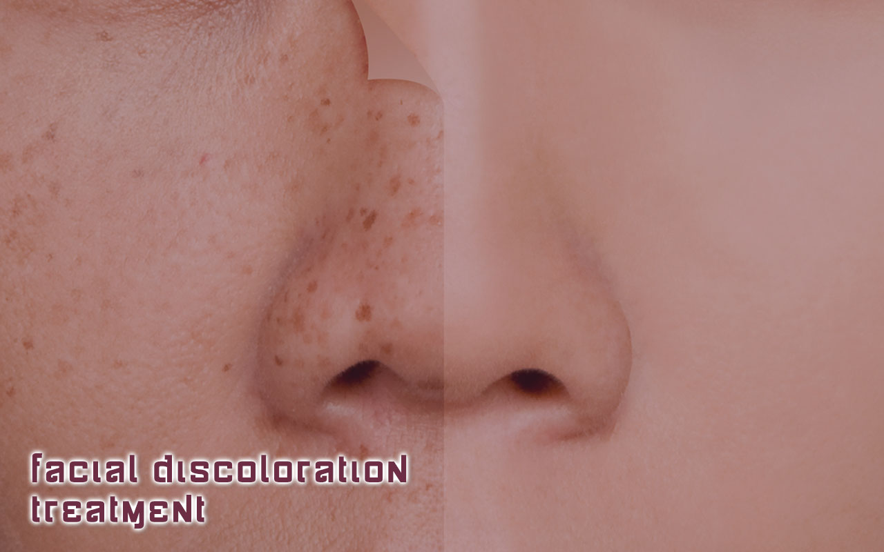 Facial Discoloration Treatment