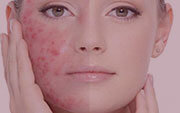 Anti Acne Facial