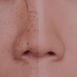 Facial Discoloration Treatment